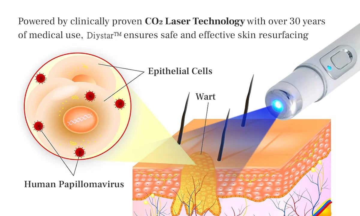 Lápiz láser para eliminar lunares y verrugas DIYSTAR™ LumeSkin