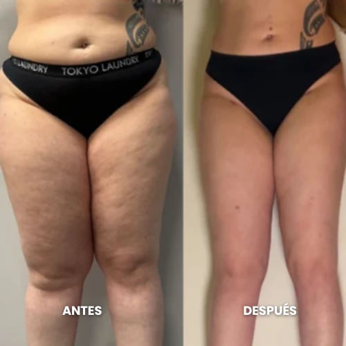 Resultado de cliente con lipedema