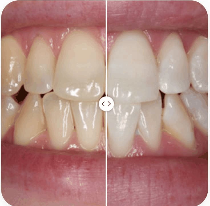 Antes y después de blanqueamiento dental