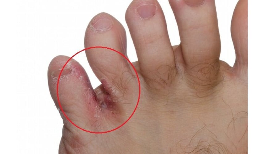 Cómo eliminar la tiña de los pies
