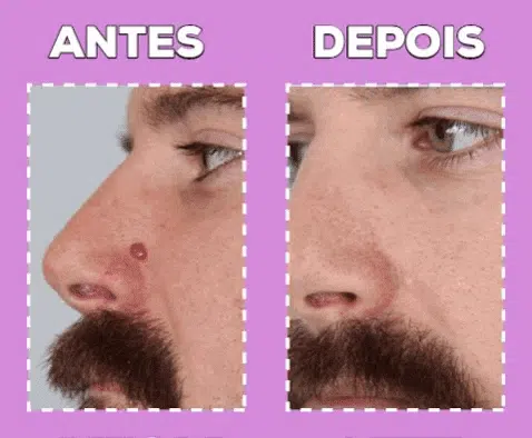Removedor de Verrugas