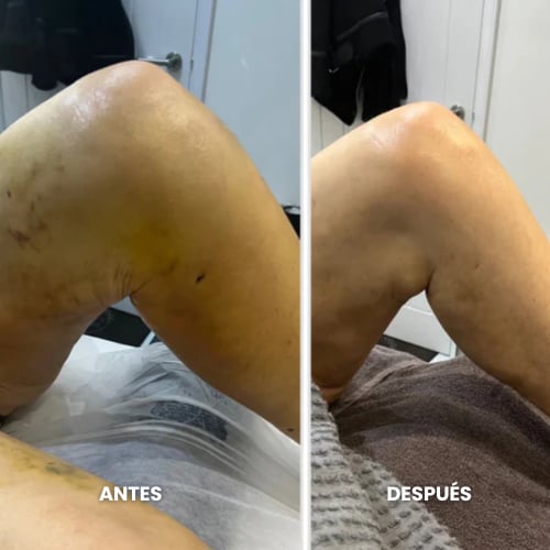 Resultado en piernas con várices y retención de líquidos