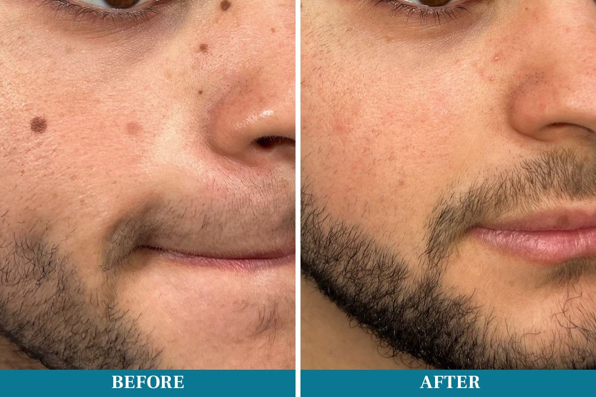 Lápiz láser para eliminar lunares y verrugas DIYSTAR™ LumeSkin