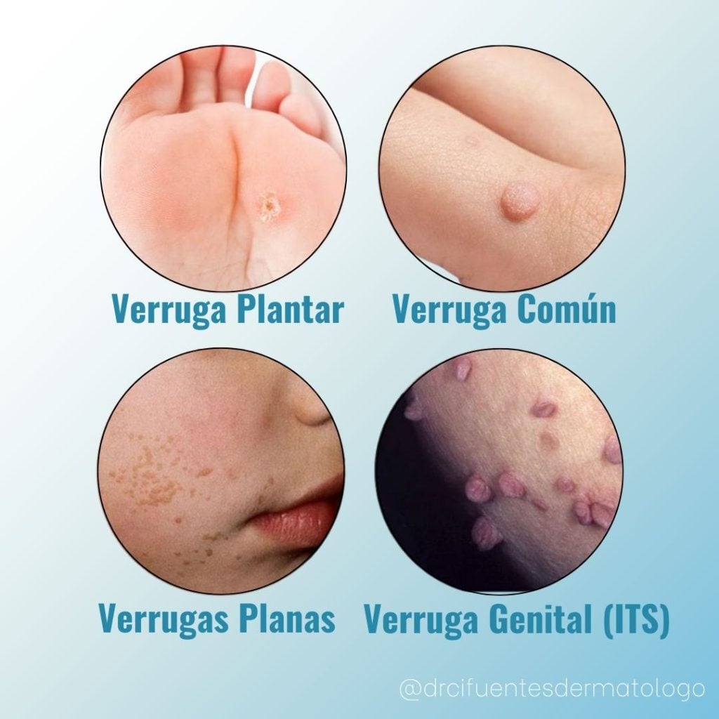 Qué son las Verrugas y por Qué se Producen - Doctor Cifuentes Dermatologo
