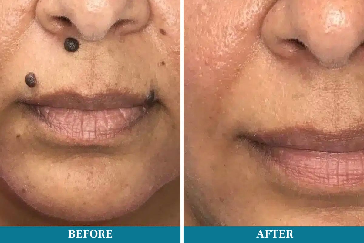 Lápiz láser para eliminar lunares y verrugas DIYSTAR™ LumeSkin