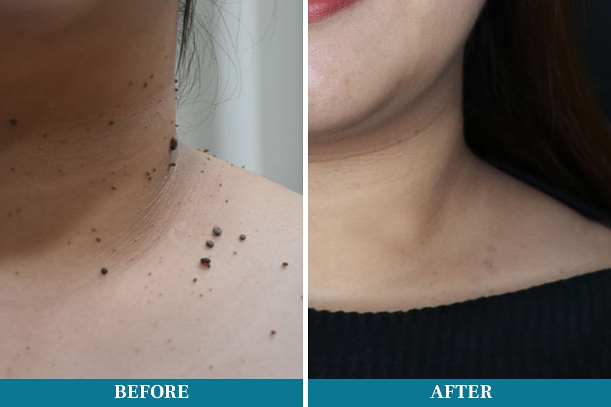 Lápiz láser para eliminar lunares y verrugas DIYSTAR™ LumeSkin