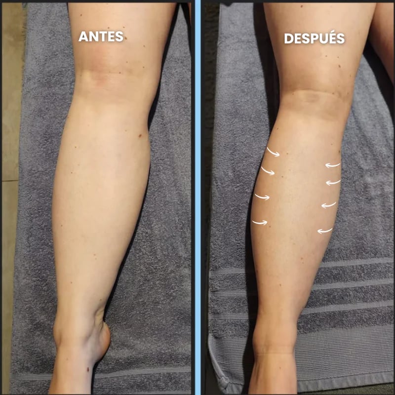 Resultado en piernas con retención de líquidos