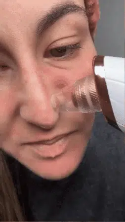 ✨ Succionador de Espinillas y Puntos Negros Profesional