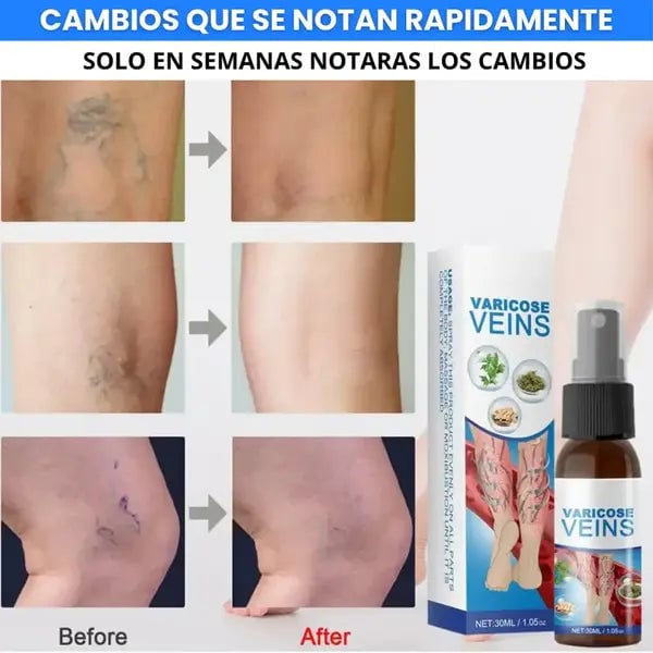 🩺 Varicose Veins™ Pro Tratamiento Intensivo Avanzado para Venas, Varices y Piernas Cansadas (Oferta 2x1)