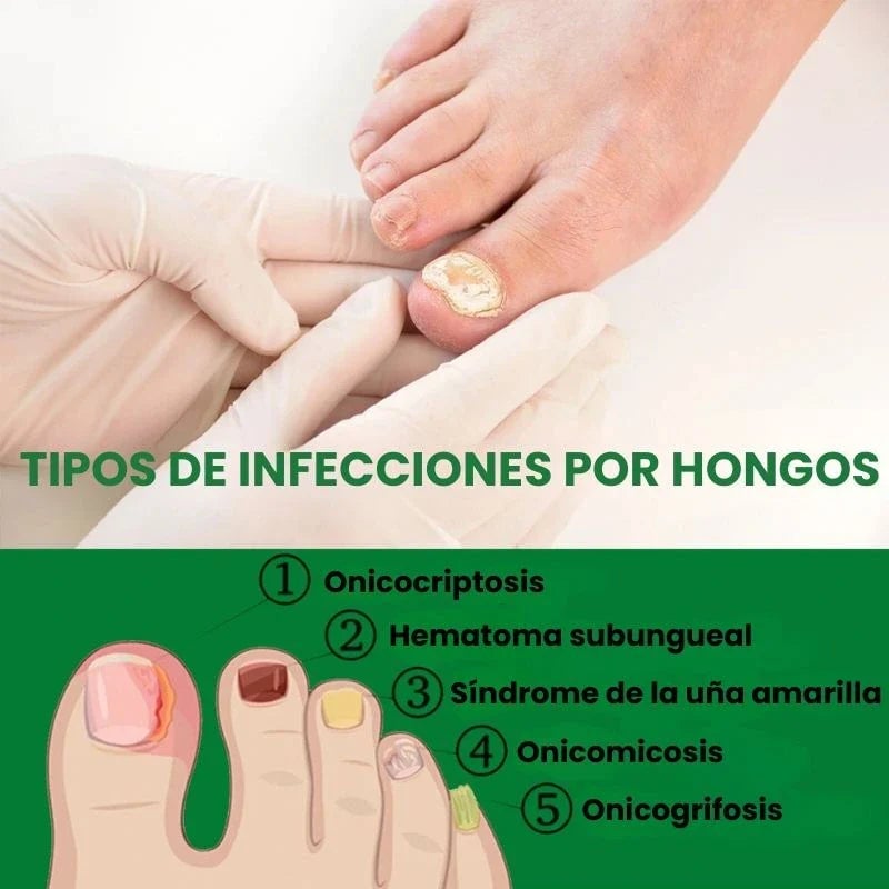 7 Days Fungus Free Nails® - Protege y elimina el hongo de tus Uñas (50ml)