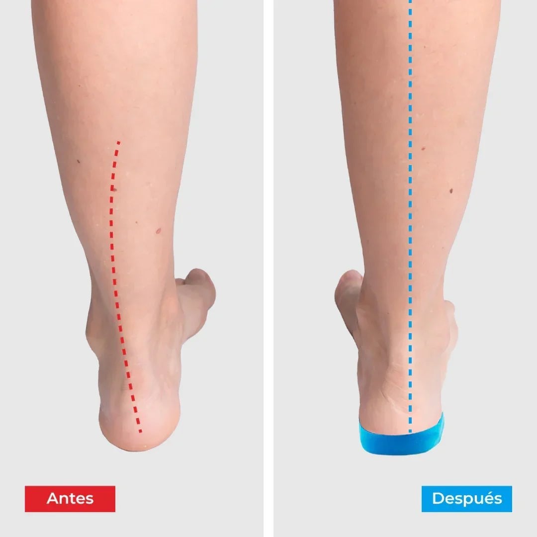 Plantillas ComfyFeet - Disfruta de días sin dolor, sin tratamientos caros ni visitas al médico....
