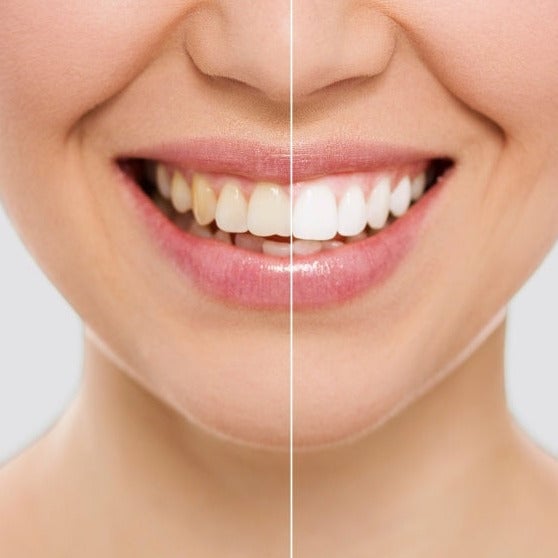 LÁPIZ BLANQUEADOR DE DIENTES – Elimina Manchas y Blanquea tu Sonrisa en Días | SMILE WHITE™