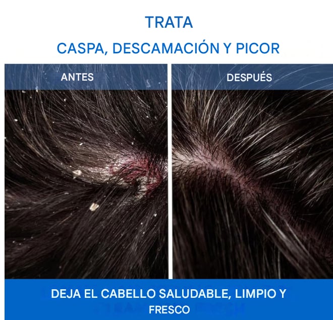 馃SHAMPOO NIPPORI MEDICO -Adi贸s Caspa, Mal Olor y Picaz贸n en 3 Aplicaciones