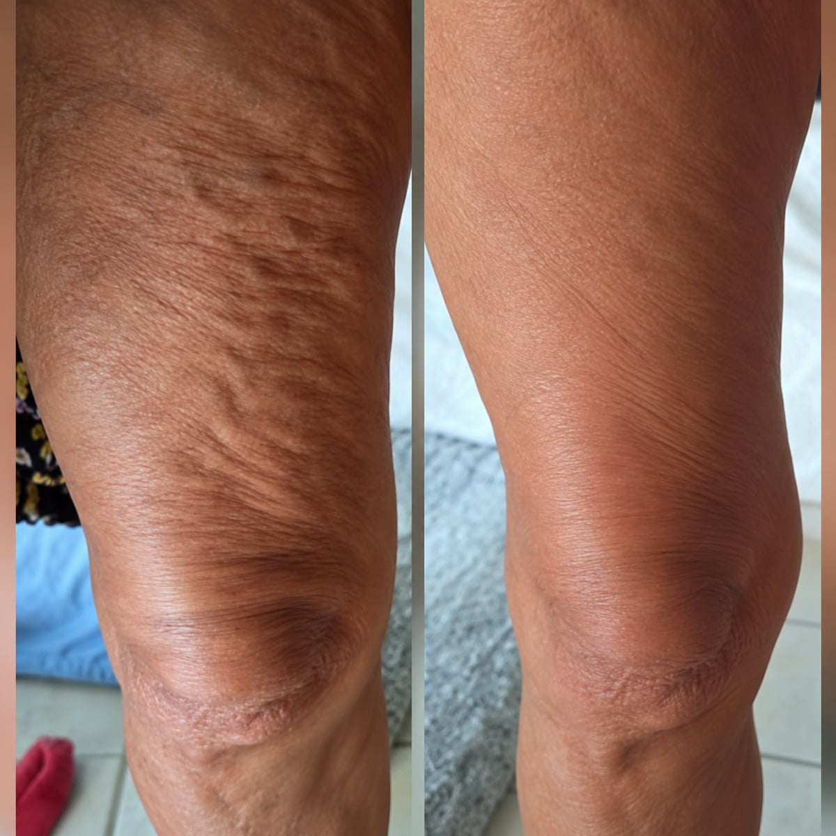 AntiCelulitis - Reafirma y suaviza tu piel