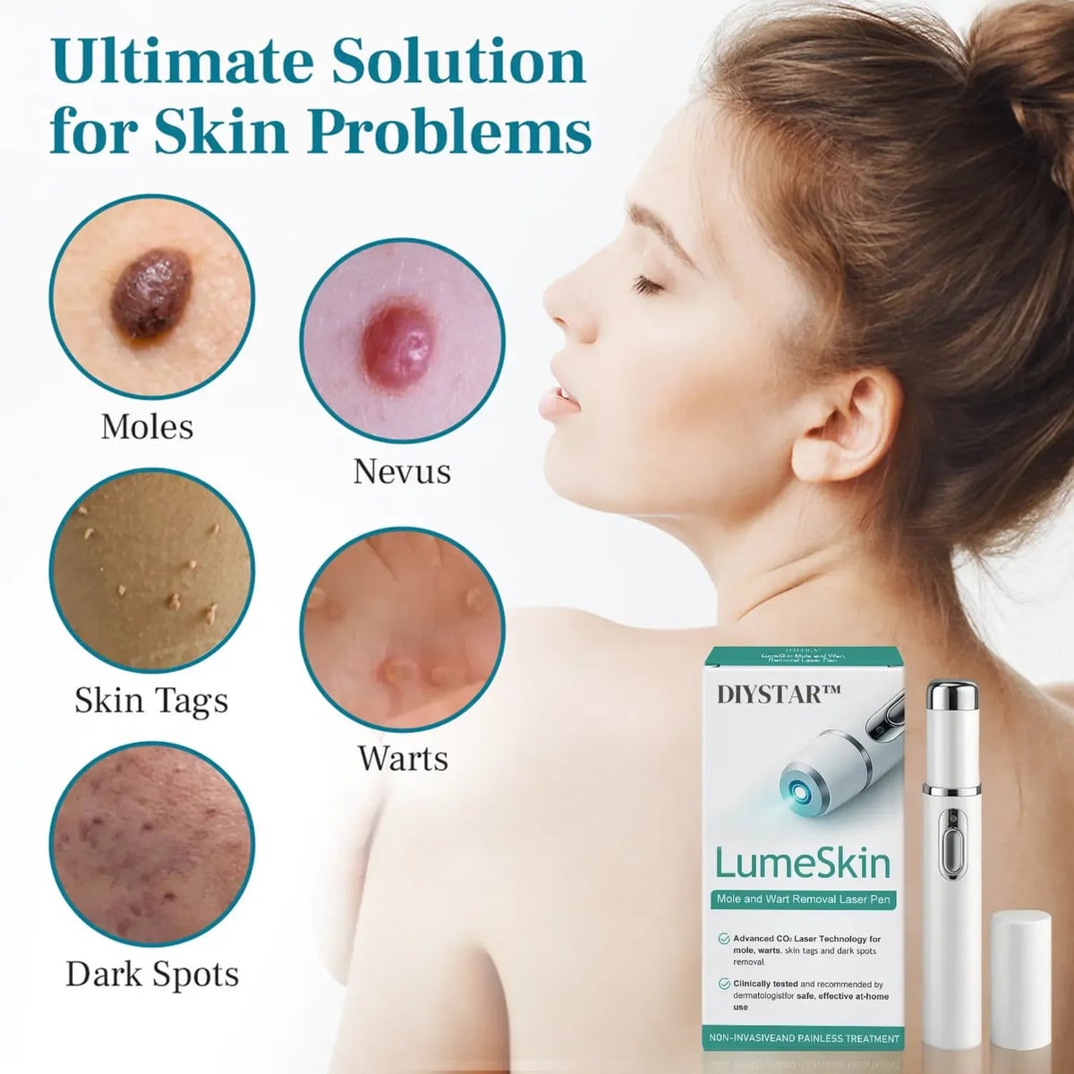 LÁPIZ LÁSER PARA ELIMINAR VERRUGAS Y LUNARES + ENVIO GRATIS