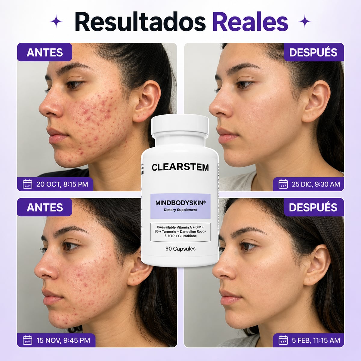 MINDBODYSKIN® Acaba con el Acné Hormonal en 7 Días + ENVIO GRATIS 🎁
