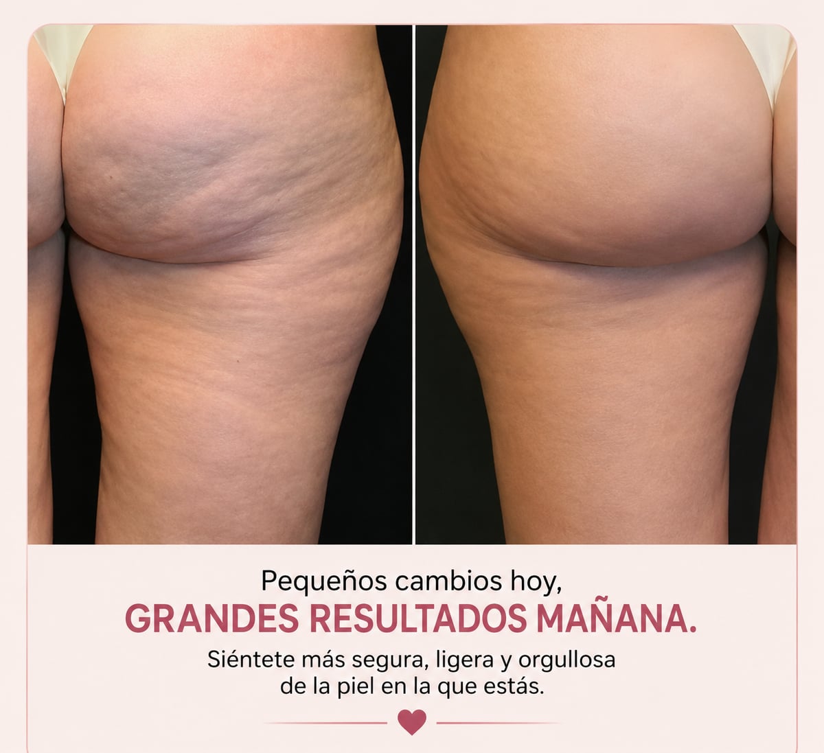 ACEITE PARA MASAJES ANTICELULITIS