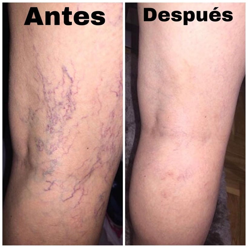 Spray Anti-Varices 100% Natural OFERTA 2 X 1