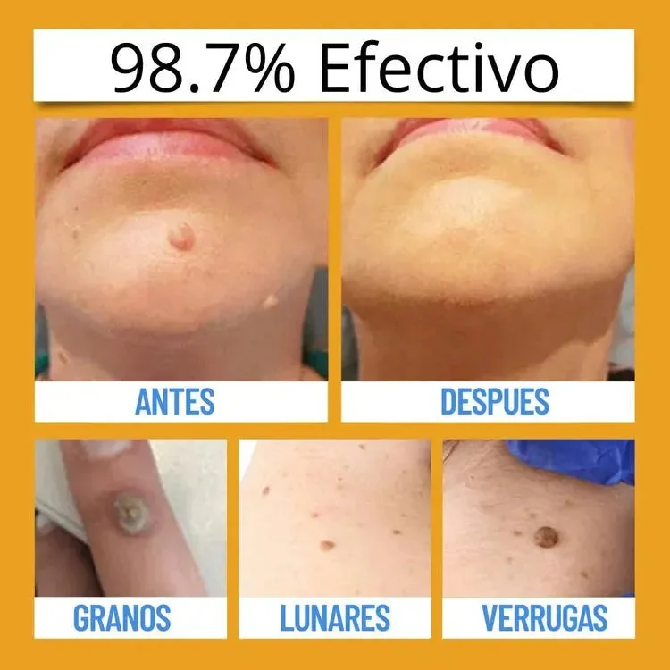 ELIMINADOR DE VERRUGAS TAG RECEDE