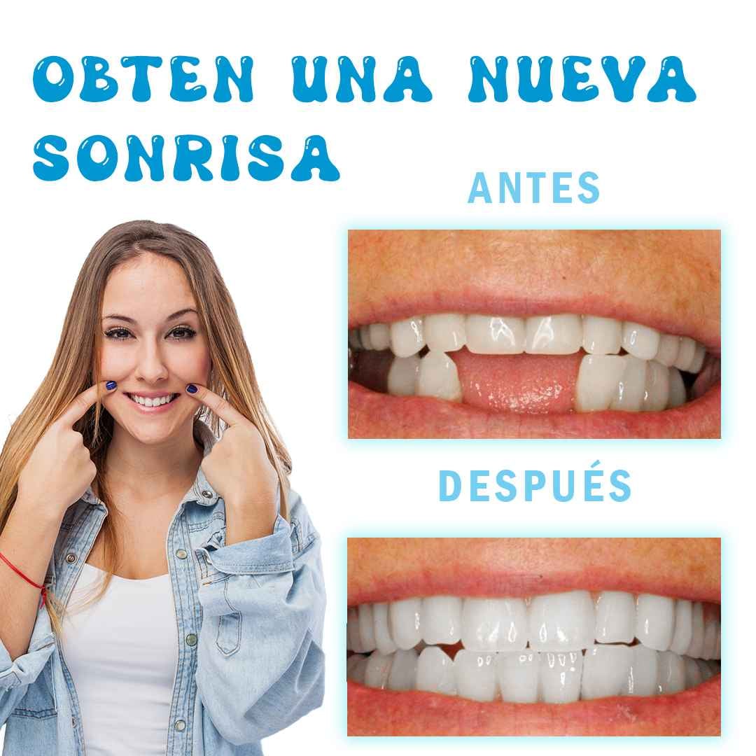 ULTIMAS UNIDADES - RESINA DENTAL MOLDEABLE 💫 ENVÍO GRATIS