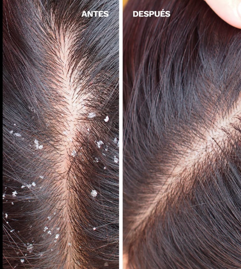 Nippori - Shampoo elimina la caspa en 7 Dias.