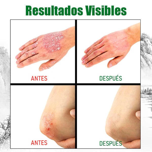 PSORIASIS™ | Alivia la picazón y el enrojecimiento de la piel desde la primera aplicación ☀️