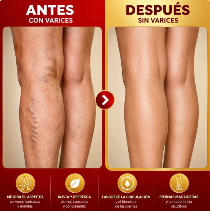 VARICOSE :Piernas más ligeras, piel más suave.