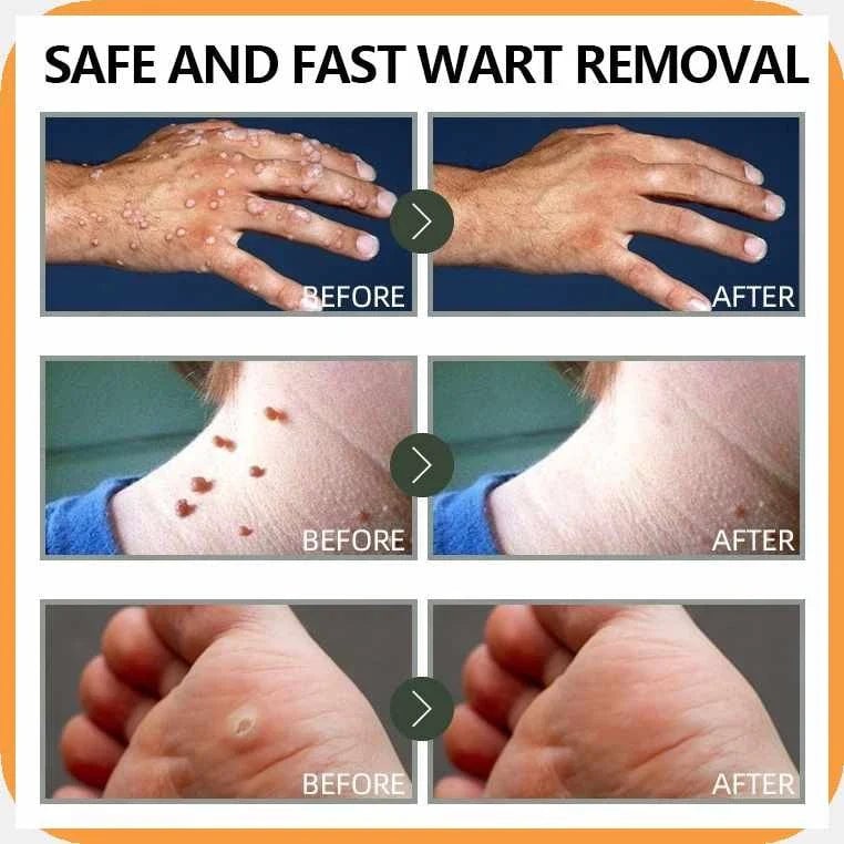 WART REMOVER
