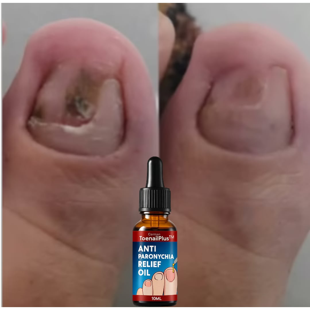 Aceite Eliminador de Hongos y Uñas Encarnadas EHOHE + ENVIO GRATIS