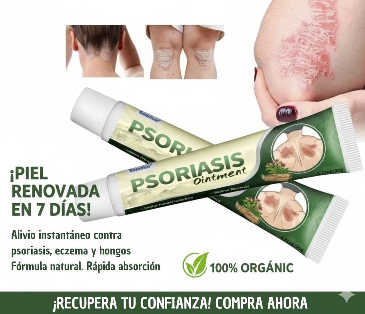 ✅ PSORIASIS™ | Alivia la picazón y el enrojecimiento de la piel desde la primera aplicación ☀️