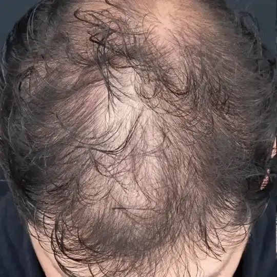 Fórmula Capilar DHT Blocker™ | Apoya el Crecimiento y Fortalece tu Cabello 👨⚕️
