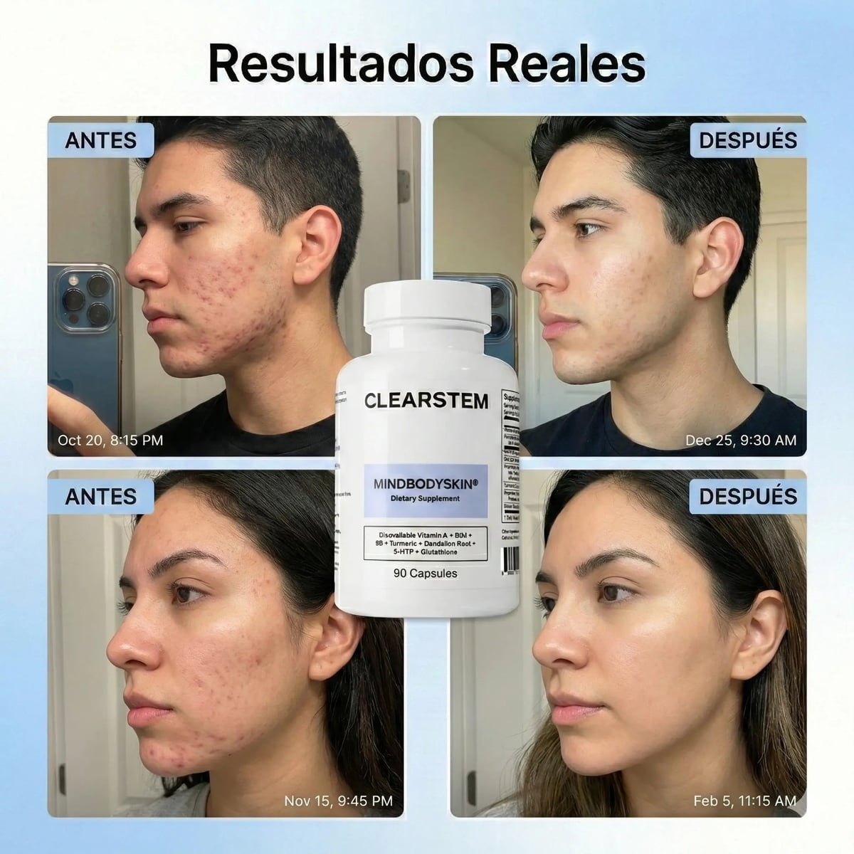 MINDBODYSKIN Clearstem - Acaba con el Acné Hormonal en 7 Días.
