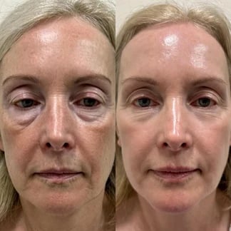 Medicube Bálsamo Antiedad – Efecto Lifting, Firmeza y Volumen para Piel Madura