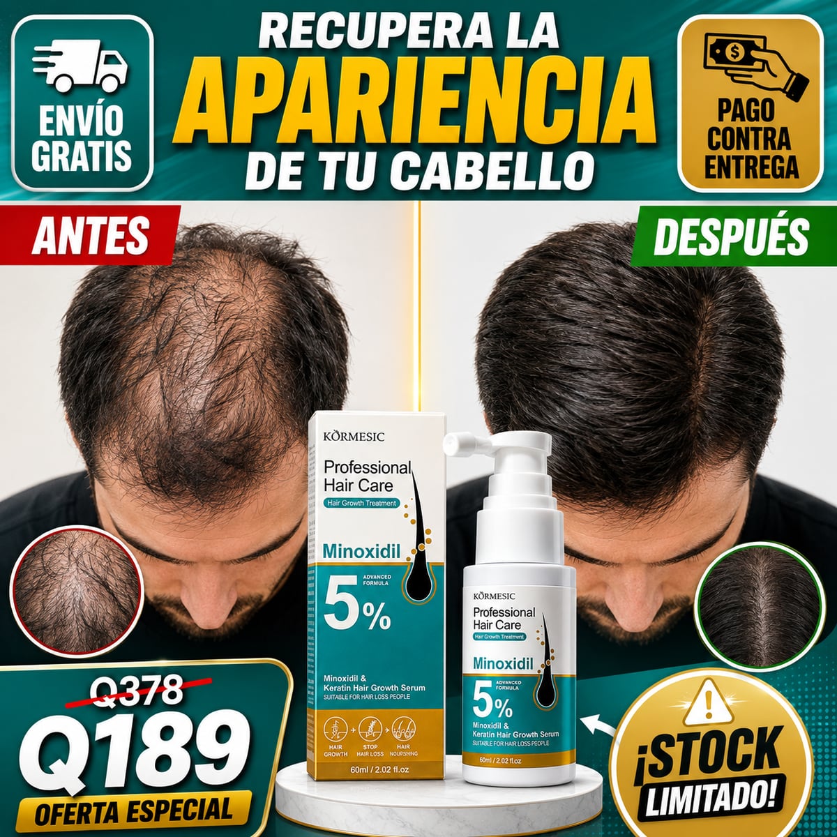 Combo Minoxidil Crema Y Serum al 5% para un Cabello Más Fuerte, Denso y con Mayor Crecimiento ✅