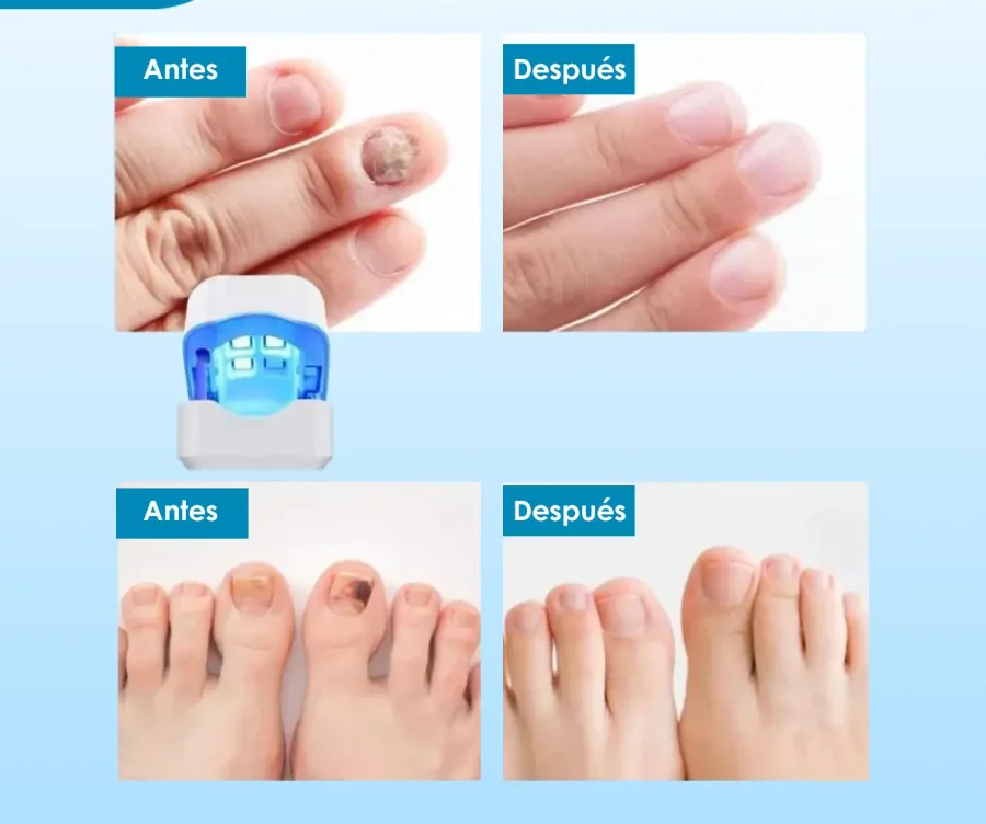 Laser Para Quitar Hongos De Las Uñas. (Onicomicosis Láser)®