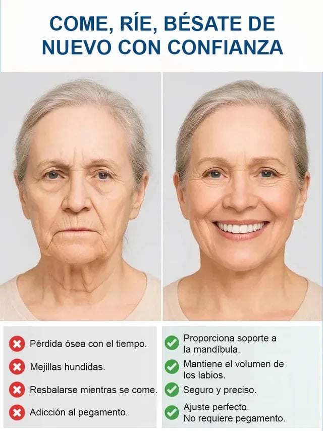 Set de prótesis dentales de soporte esquelético total