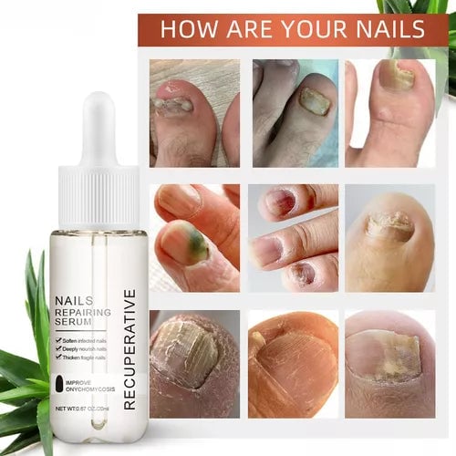 7 días de crecimiento y fortalecimiento de uñas suero 0.7 fl oz solución suavizante de onicomicosis aceite de tratamiento de uñas para uñas descoloridas y dañadas