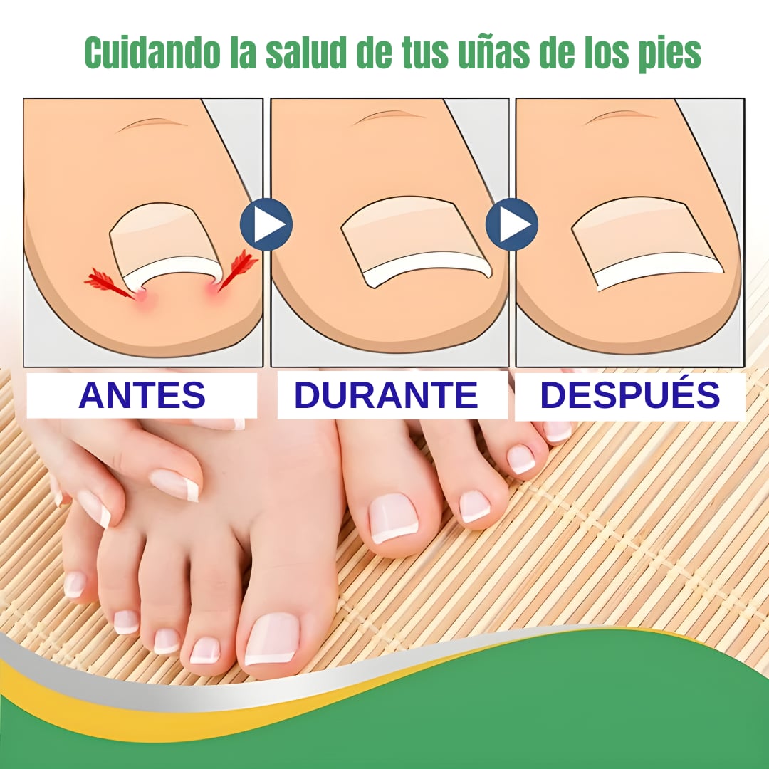 ULTIMAS UNIDADES - PARCHE REPARADOR UÑA – ELIMINA HONGOS, PROTEGE Y RECUPERA UÑAS ENCARNADAS + ENVIO GRATIS