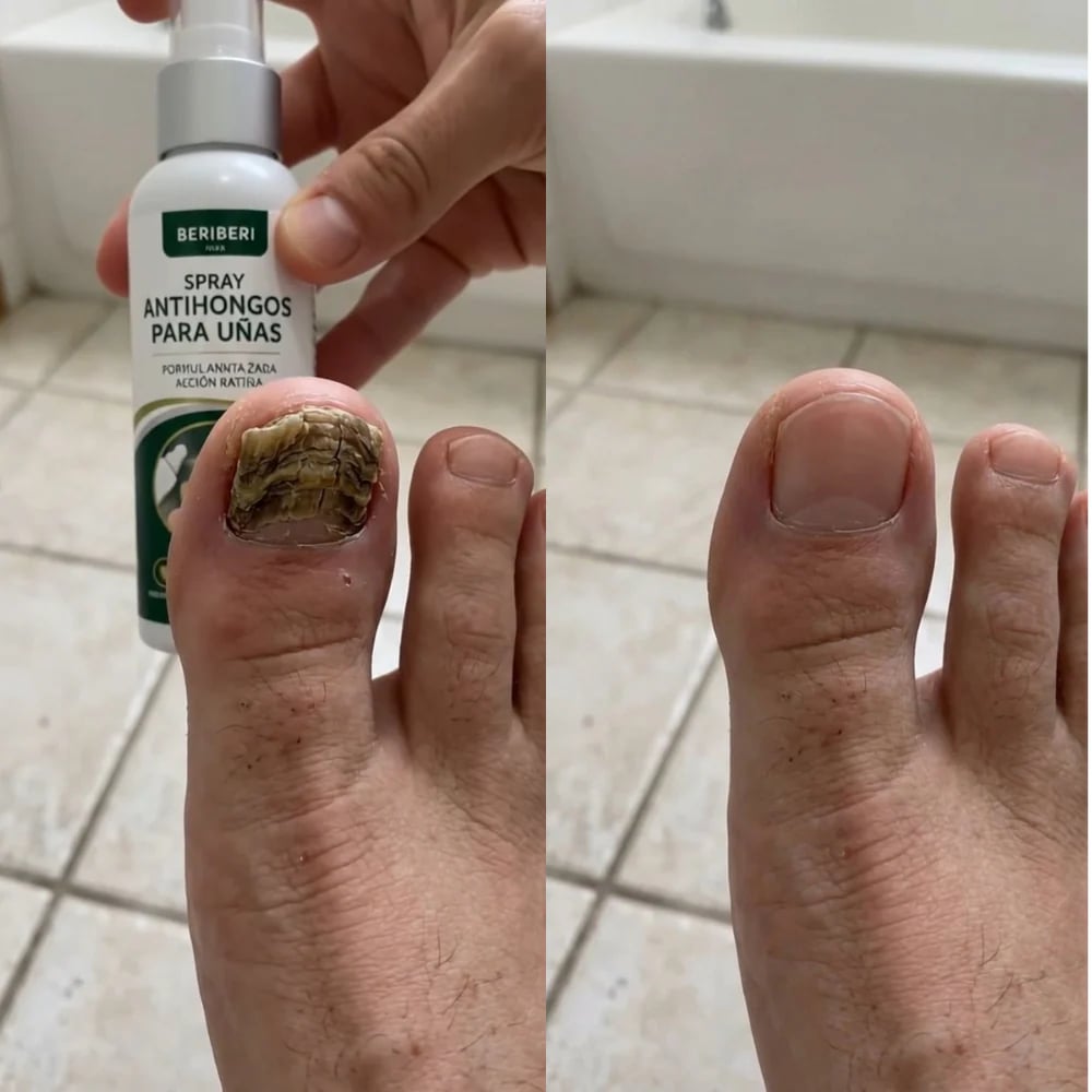 Beriberi™ Elimina hongos y picazón