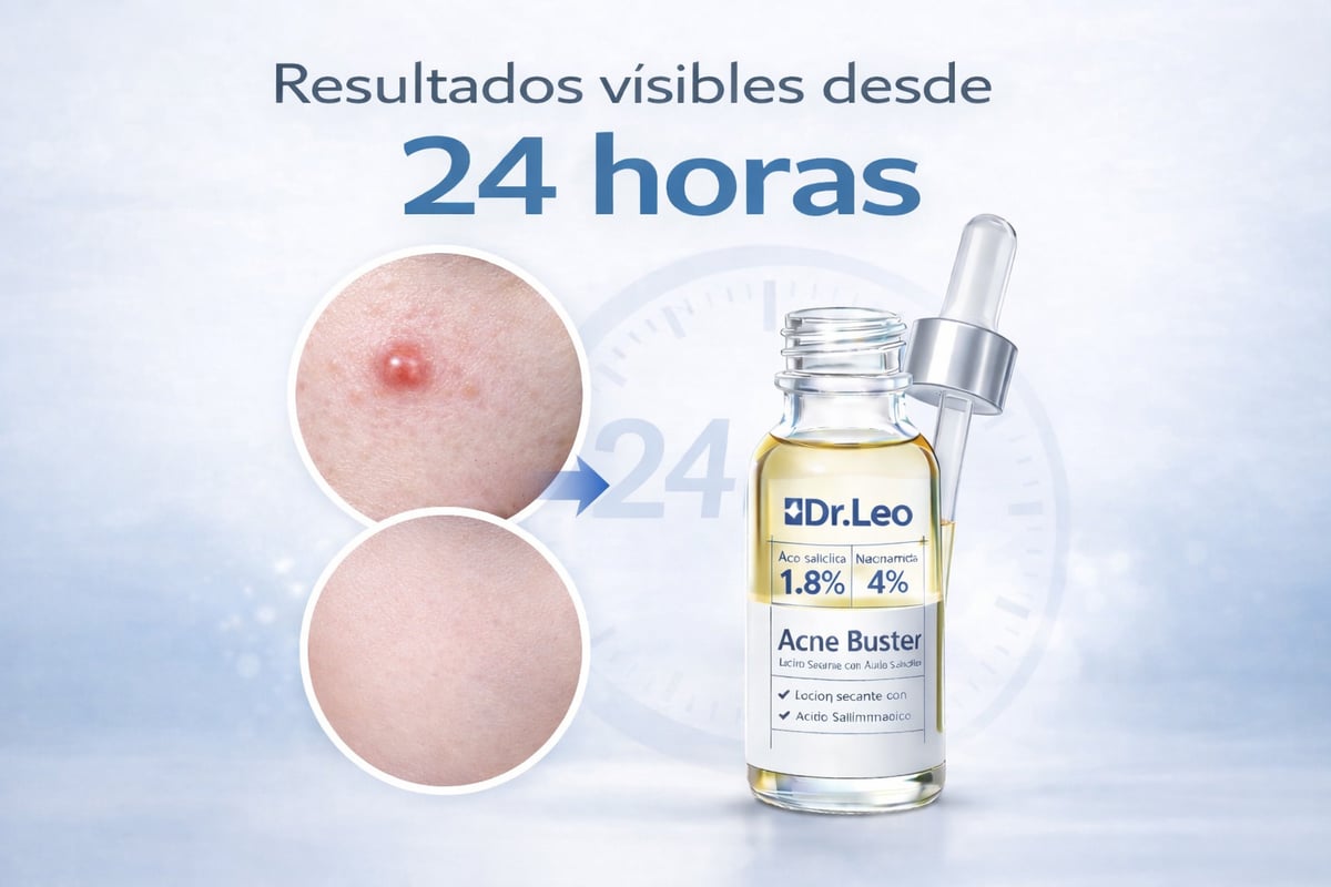 ACNE BUSTER- ACN脡 ELIMINADO EN 24 HORAS - GARANTIZADO馃嚭馃嚫 ORIGINAL