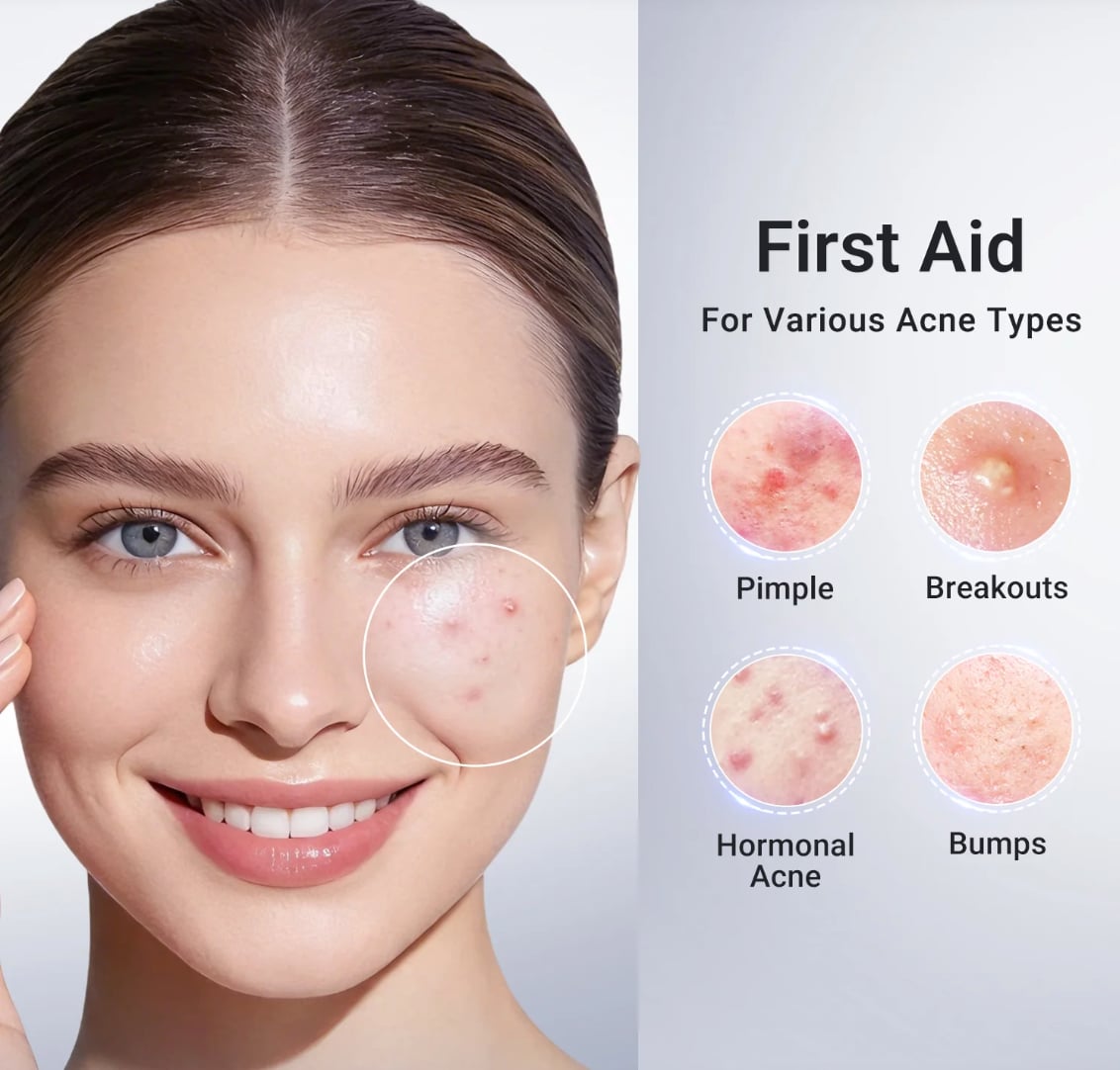 ACNE BUSTER- ACN脡 ELIMINADO EN 24 HORAS - GARANTIZADO馃嚭馃嚫 ORIGINAL