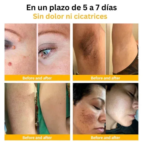 ELIMINADOR DE VERRUGAS TAG RECEDE