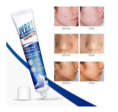 WART REMOVER - Elimina verrugas y lunares carnosos