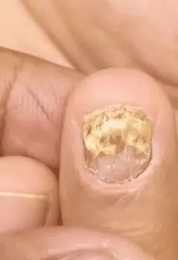 JoyPretty™ ¡Elimina los hongos de tus uñas de raíz!