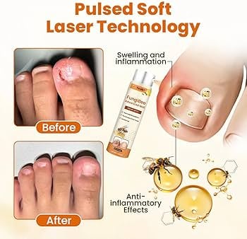 🐝FUNGI BEE - SPRAY - RESTAURADOR DE UÑAS ANTI-HONGOS CON VENENO DE ABEJA🐝