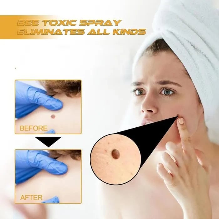 ELIMINADOR DE VERRUGAS ORIGINAL TAG RECEDE + ENVIO GRATIS
