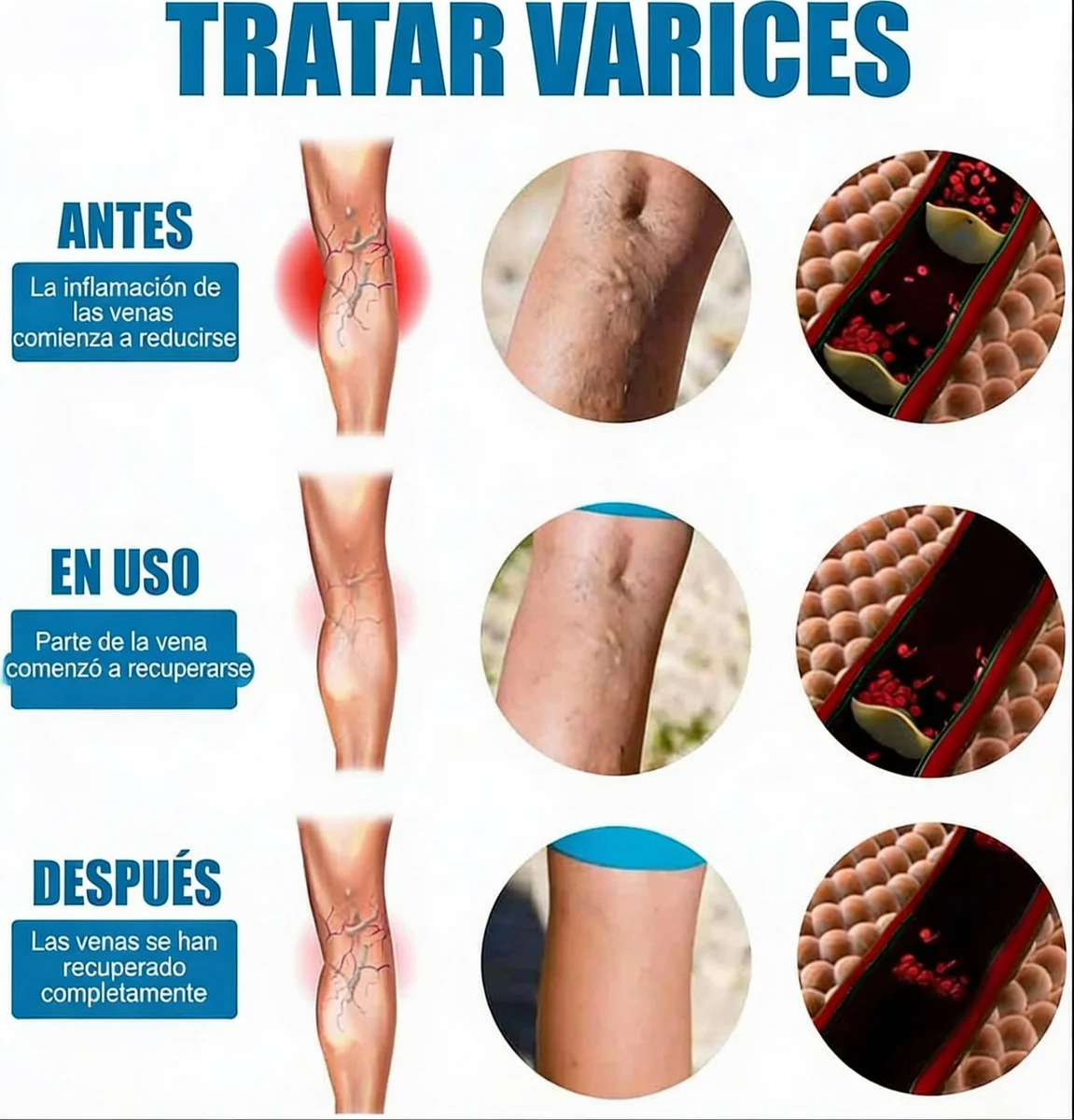 Spray Milagroso Para Venas Varicosas🦵✨