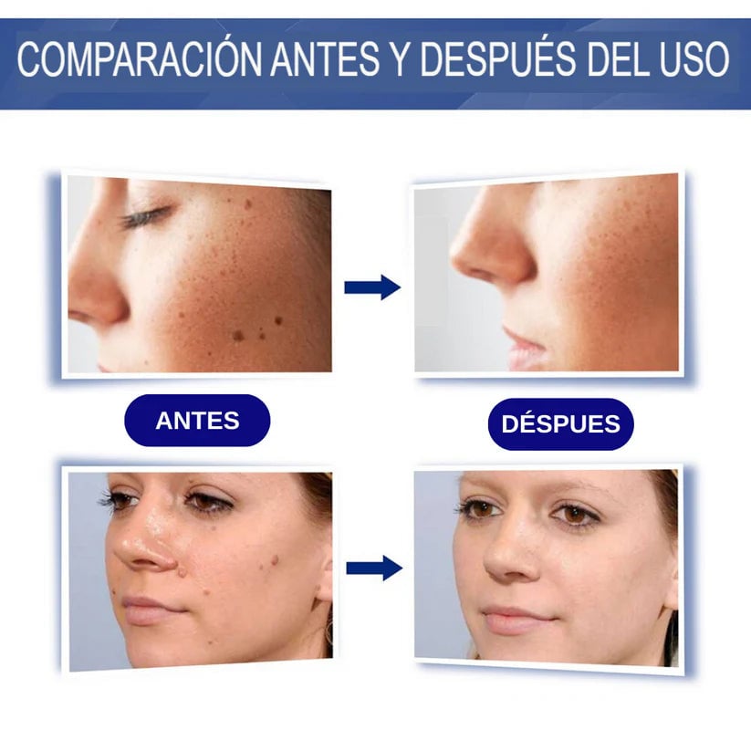 WART REMOVER - Elimina verrugas y lunares carnosos