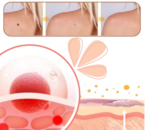 Spray BeeVenom™ para Verrugas y de Cuidado Localizado para la Piel